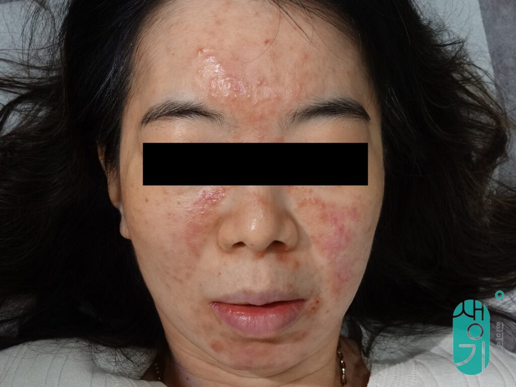 치료 전 얼굴 상태