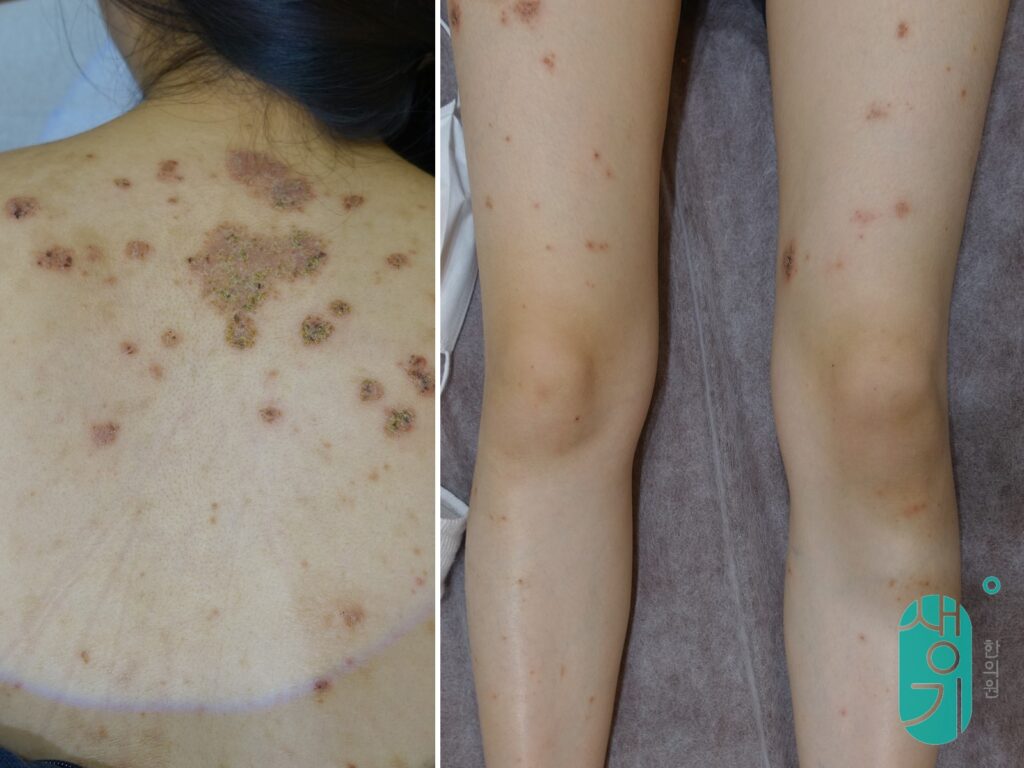 치료 전 등과 다리 상태