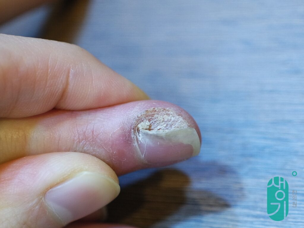 치료 전 손톱 주변 사마귀 상태