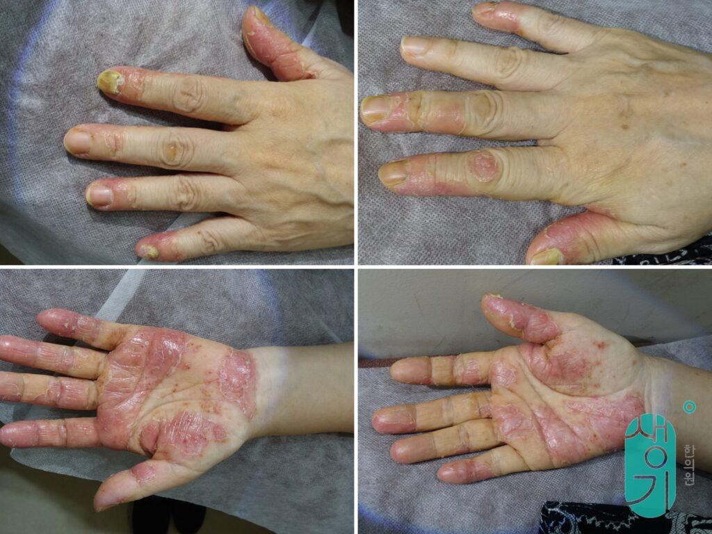 치료 전 양손 손등과 손바닥의 농포성 건선 상태