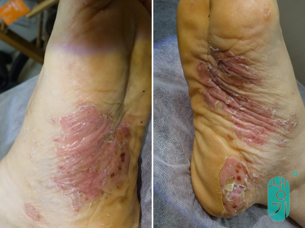 치료 전 양발 발바닥의 농포성 건선 상태